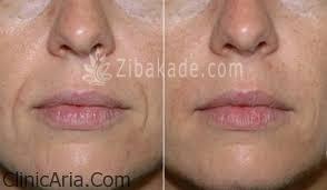 میکرونیدلینگ